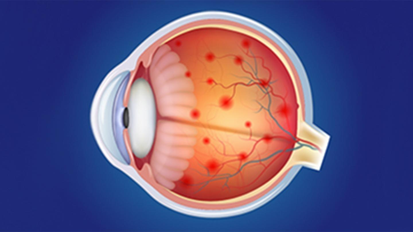 Diabetic_Retinopathy